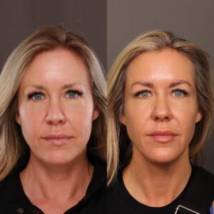 After Image: Eyebrow Transplant