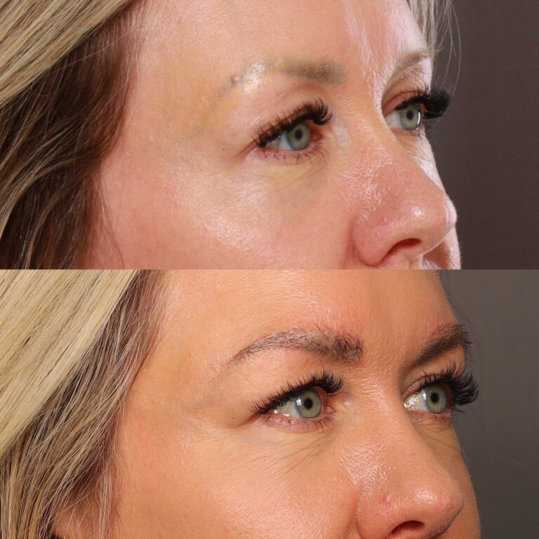 Before Image: Eyebrow Transplant - front