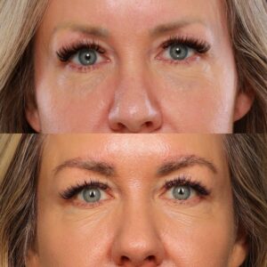 Before Image: Eyebrow Transplant