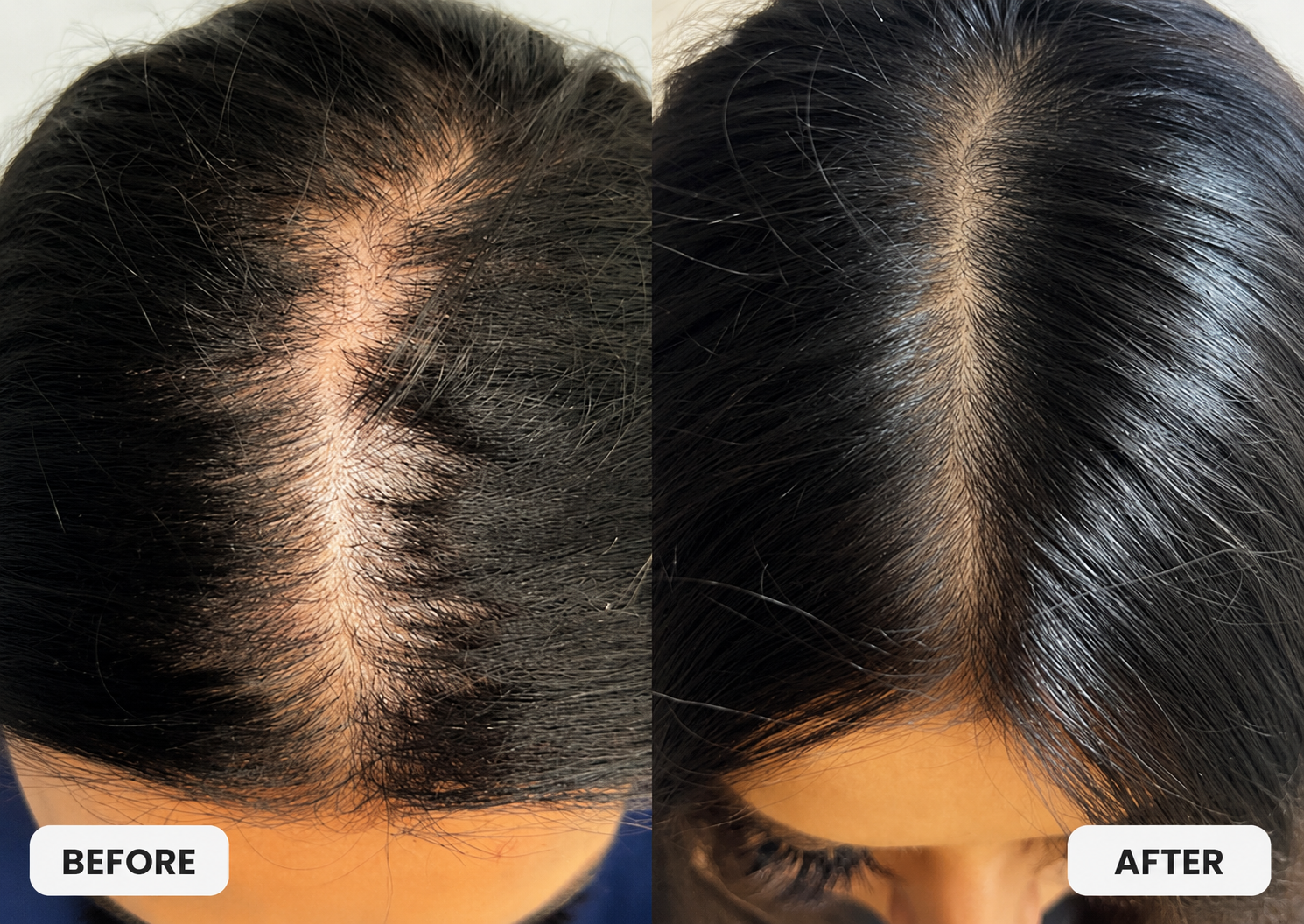 After HydraScalp with Keravive™ Treatment + Daily Use of HydraScalp with Keravive™ Peptide Spray