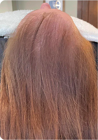 After 1 Hydrafacial HydraScalp with Keravive™ Treatment and Daily Use of HydraScalp with Keravive™ Peptide Spray Includes daily use of take-home peptide spray. Individual results may vary.