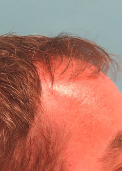 FUT Hair Transplant by Dr. Thompson