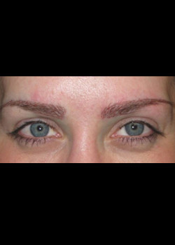 Eyebrow Transplant by Dr. Thompson