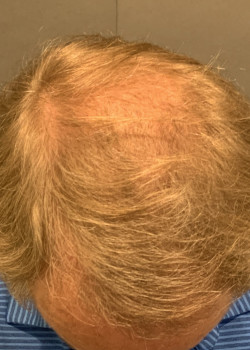 FUT Hair Transplant by Dr. Thompson