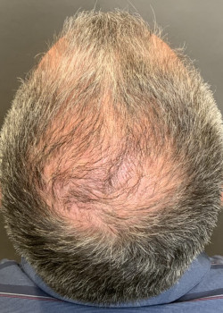 Hair Transplant post Mohs Reconstruction by Dr. Thompson