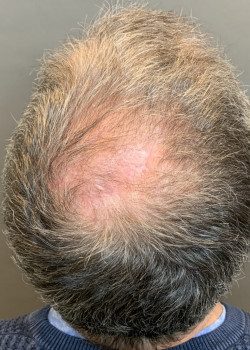 Hair Transplant post Mohs Reconstruction by Dr. Thompson