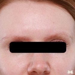 Eyebrow Transplant by: Dr. Thompson
