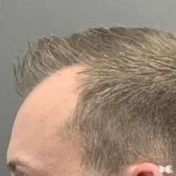 FUE Hair Transplant by: Dr. Henstrom